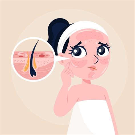 Image result for Sebum Plug Extraction