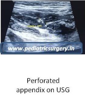 Pediatric Acute Appendicitis | pediatricsurgery.in