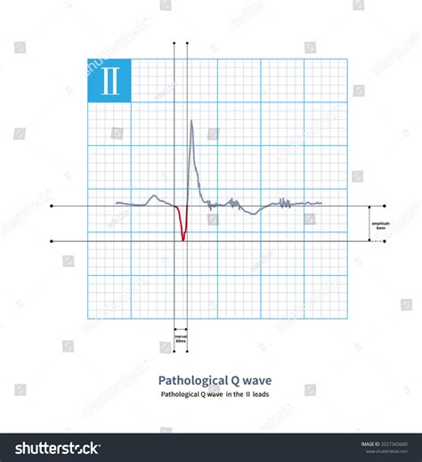 Pathological Q Waves