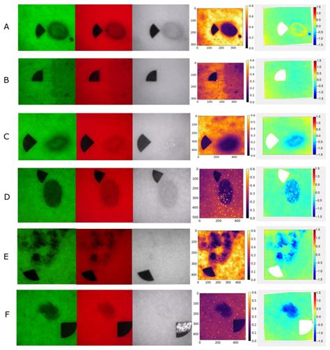 Multispectral Imaging Analysis of Skin Lesions in Patients with ...