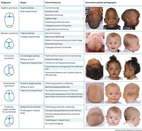 Recognising a child with isolated craniosynostosis | The BMJ