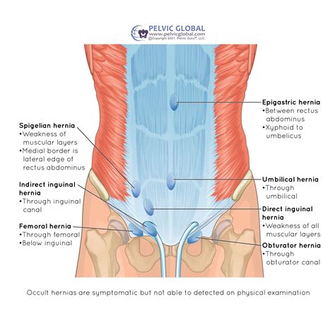 La Hernia Inguinal Duele In Spanish