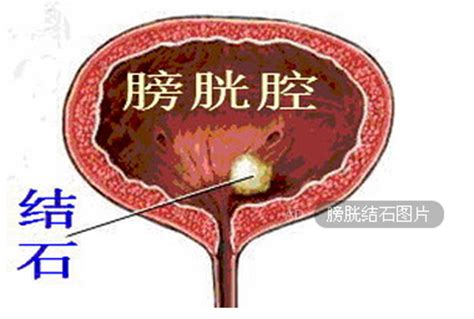 膀胱结石 有哪几种治疗方法-治疗膀胱结石的方法哪种好