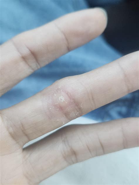 Hard bump on finger : r/DermatologyQuestions