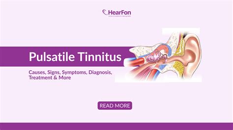 A 101 Guide To Pulsatile Tinnitus Curated By Audiologists @ HearFon