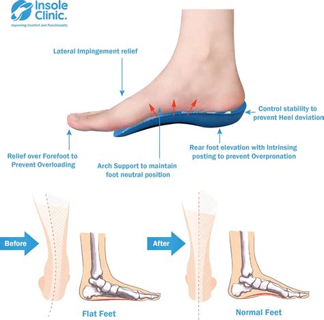 Buy Insole Clinic® 3/4L Orthotic Insoles, Plantar Fasciitis Medial Arch ...