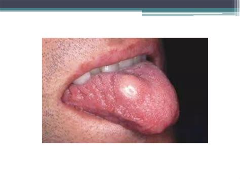 D.D of tongue swelling | PPTX