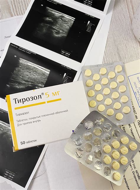 Жизнь с гиперактивной щитовидной железой: отзыв пациента о лечении