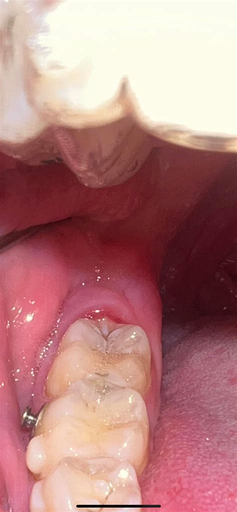 Swelling Of Gums Behind Molars