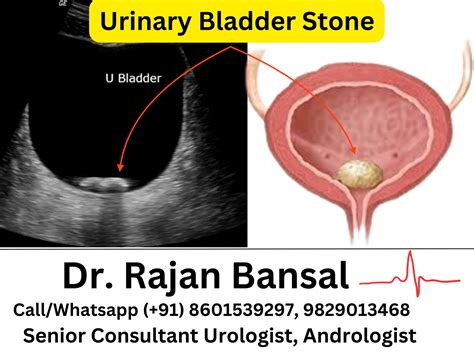 Urinary Tract Stones Man Has Bladder Stone The Size Of An Ostrich Egg - capacity of urinary bladder in male