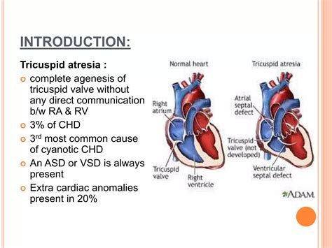 Tricuspid atresia & transposition of great arteries | PPTX