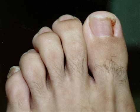 Pictures of Ingrown Toenails ~ Ingrown Toenail