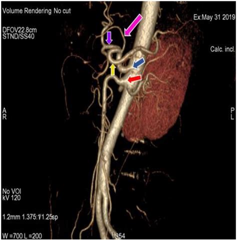 Abdominal Aorta Celiac Trunk