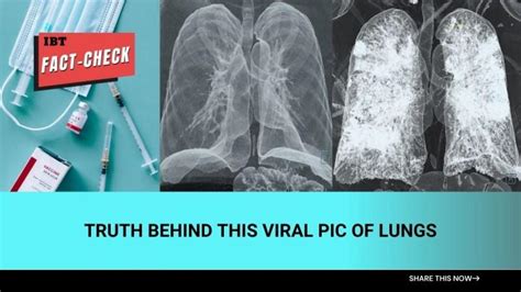 Fact check: Truth behind viral photo of CT scans comparing lungs of ...