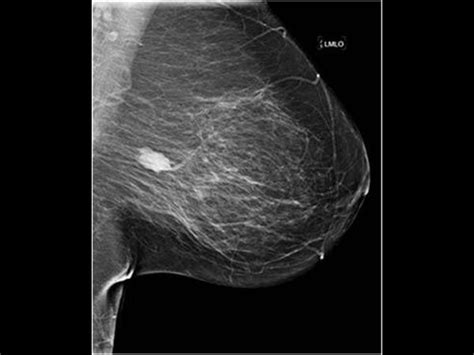Image result for Axillary Abscess