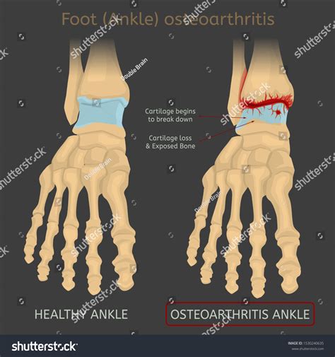 Osteoarthritis In Feet