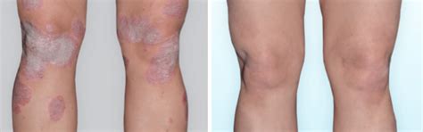 Large Patches - Eczema and Psoriasis Complete Care Bundle – Oleum Cottage