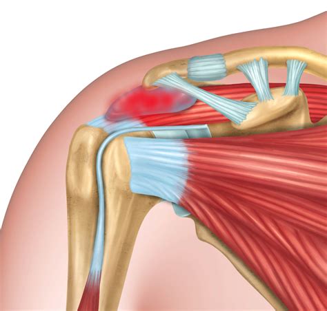 Orthopaedic & Trauma Surgeon - Shoulder - Subacromial bursitis