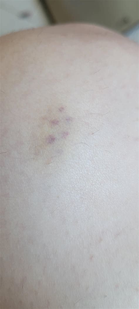 Bruise with purple spots : r/medical_advice