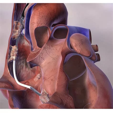 GlideLight Laser Sheath | Philips Healthcare