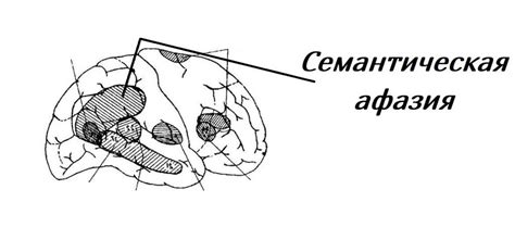 Семантическая афазия - симптомы, прогноз на лечение