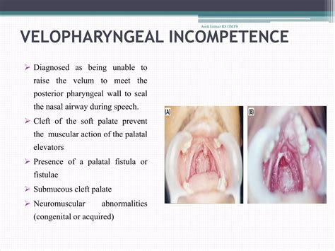 Cleft palate | PDF