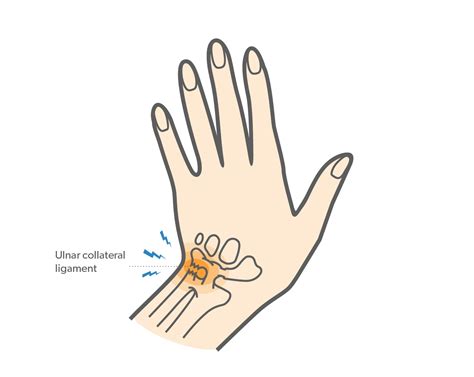 Triangular Fibrocartilage Complex (TFCC) Tear | Upswing Health