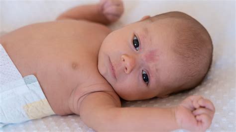 नवजात श‍िशु की गर्दन में रैशेज होने के कारण और लक्षण | Newborn Baby ...