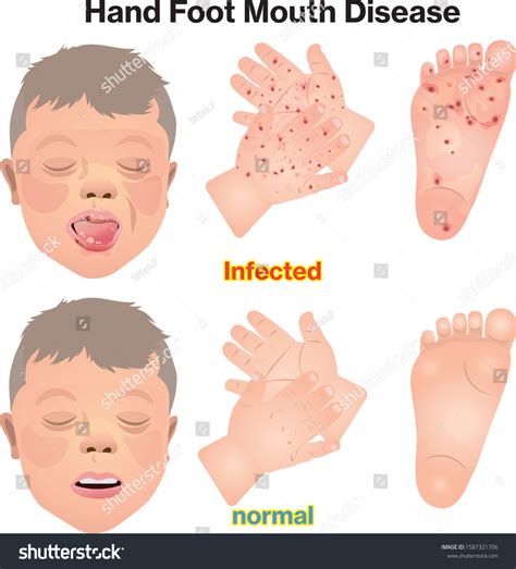 Is Hand Foot And Mouth Disease Going Around at Sasha Benningfield blog