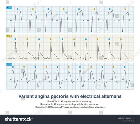 Repolarization Of The Heart