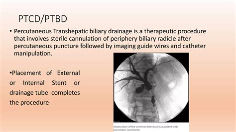 PTBD (Percutaneus trans-hepatic biliary drainage) PPT,PDF PK | PPTX