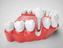 Wisdom Tooth Extraction Treatment in Pragathi Nagar
