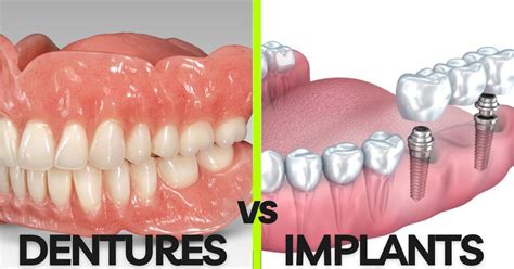 Dental Implants vs Dentures: Choosing the Best Tooth Replacement Option ...
