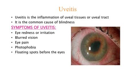 Disorders of uveal tract | PPTX