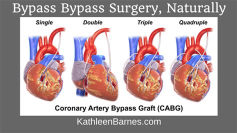 Bypassing bypass surgery, naturally - KathleenBarnes.com