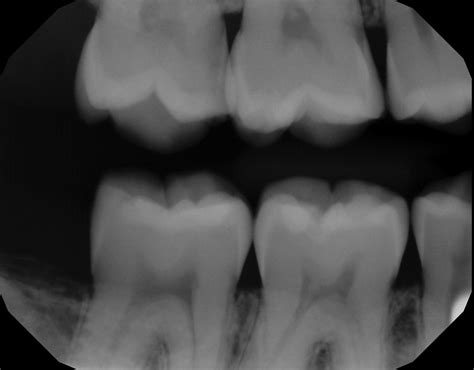 Tooth Decay X Ray Pictures at Blanca Wilkerson blog