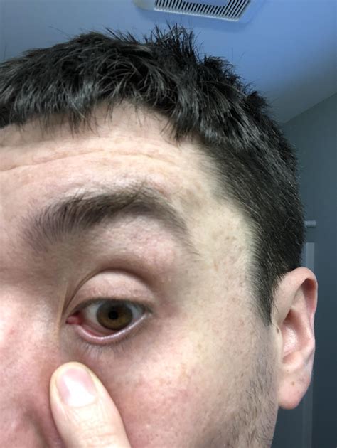 Swollen caruncle in one eye. Why? : r/eyetriage