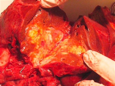 Alveolar echinococcosis in Switzerland - Gastroenterologie ...