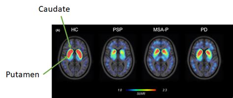 Rezultat imagine pentru Dat Brain Scan