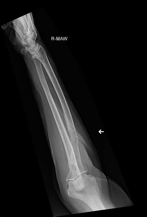 OrthoDx: Pathologic Fracture of the Forearm - Clinical Advisor