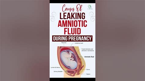 Causes Of Leaking Amniotic Fluid During Pregnancy #pregnancy # ...