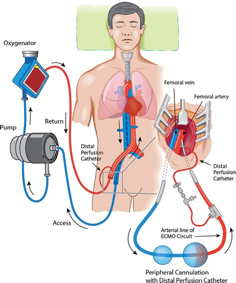 Ecmo