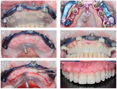 Computer Aided Full Arch Restoration by Means of One-Piece Implants and ...