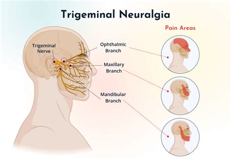 Trigeminal Neuralgia: Causes, Symptoms & Best Treatment