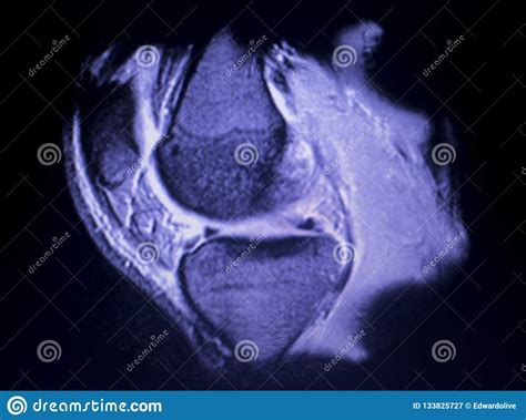 MRI Knee Meniscus Tear Scan Stock Image - Image of technology, clinic: 133825727