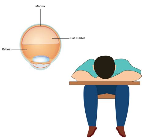Pictures Of Face Down Position After Retinal Surgery