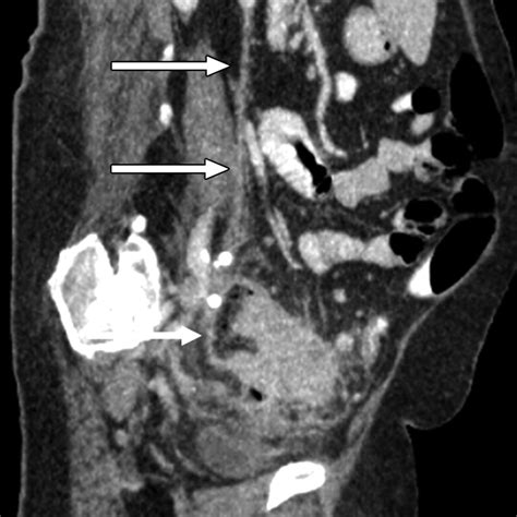 MDCT of the Ovarian Vein: Normal Anatomy and Pathology | AJR