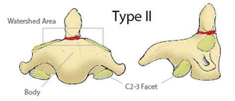 Odontoid fracture types - lerycorporation