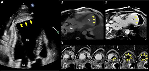Progression of Left Ventricular Aneurysm to Pseudoaneurysm on Serial ...