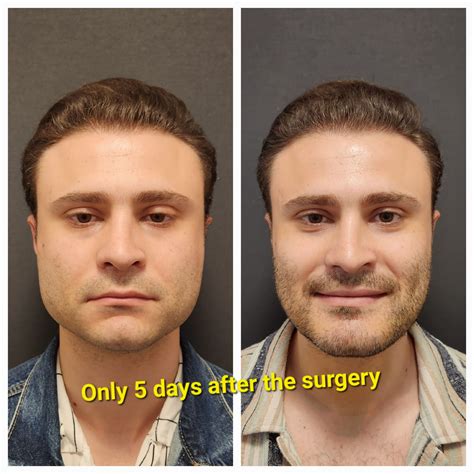 What You Need to Know About Double Jaw Surgery Before and After – Prof ...